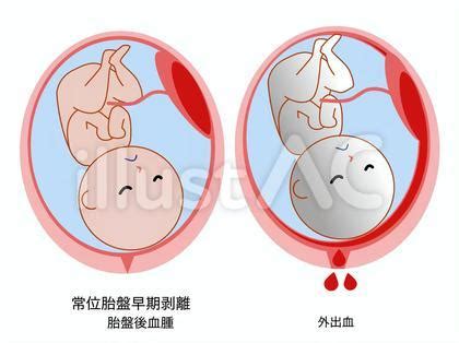 胎盤剝離後期|常位胎盤早期剥離